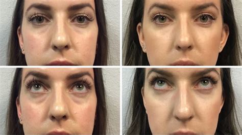Delayed swelling may also occur after the initial injection due to water attraction from the filler. . Restylane under eye filler swelling